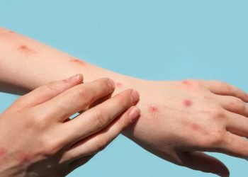 Pernambuco registra primeiro caso suspeito de varíola dos macacos