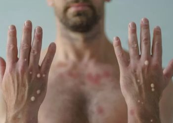 Brasil chega a 218 casos confirmados de varíola dos macacos, confirma Ministério da Saúde